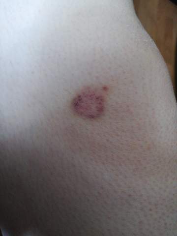 Hamatom Die Meistgelesenen Fragen Hamatom Die Meistgelesenen Fragen