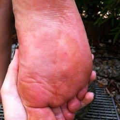 Mückenstich auf Fußsohle  - (Schmerzen, Blut, Insekten)