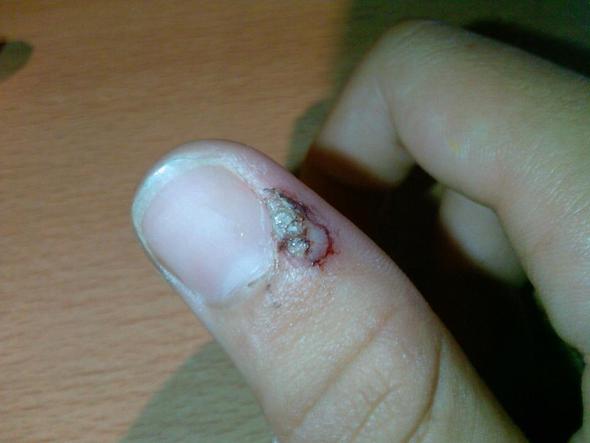 Warze Am Finger Geplatzt O Gesundheit Warzen Warze Am Finger Geplatzt O Gesundheit Warzen