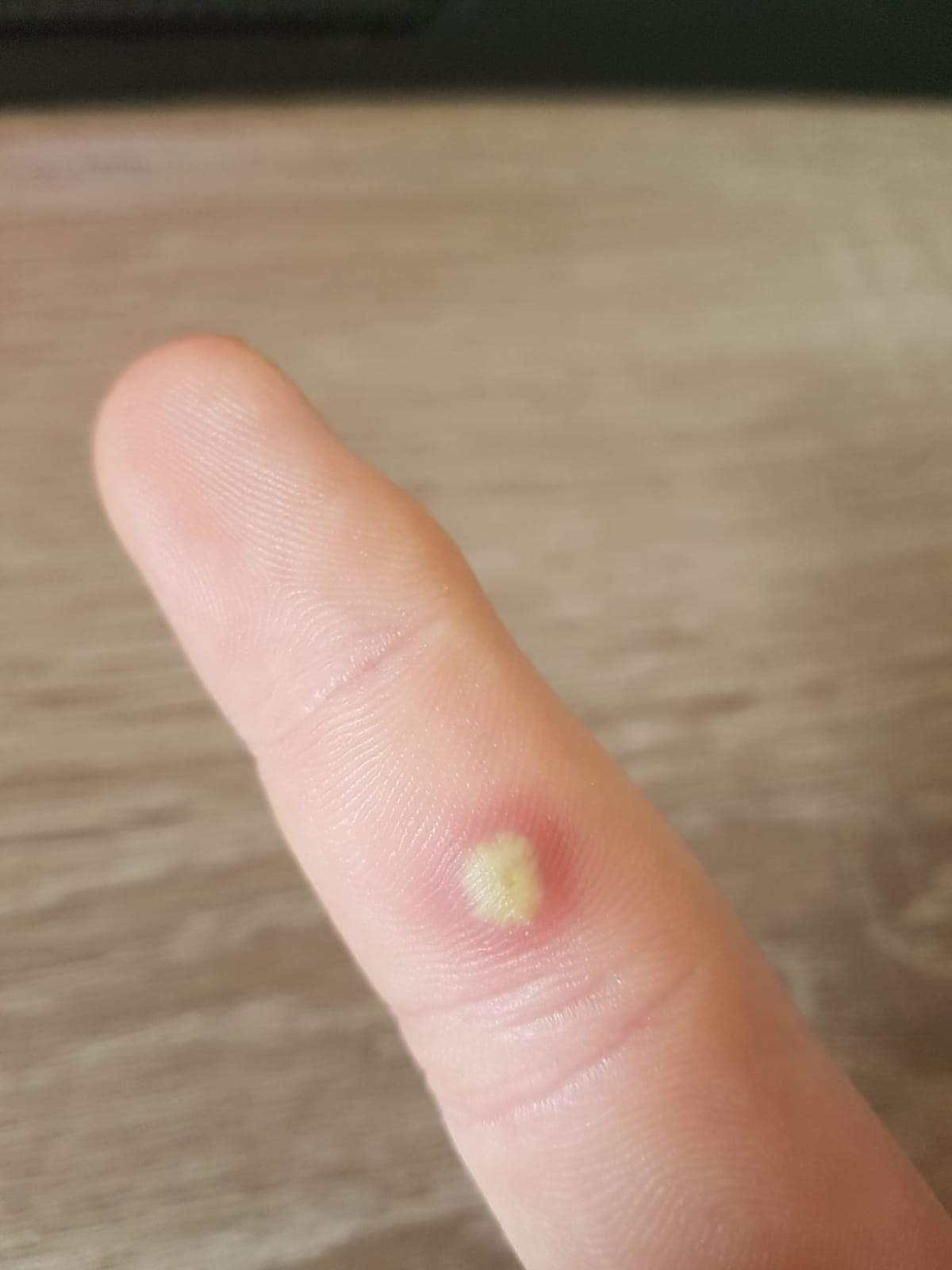 Warze am Finger geschwollen, soll ich zum Arzt? (Gesundheit und Medizin, Warzen, Warzenbehandlung)