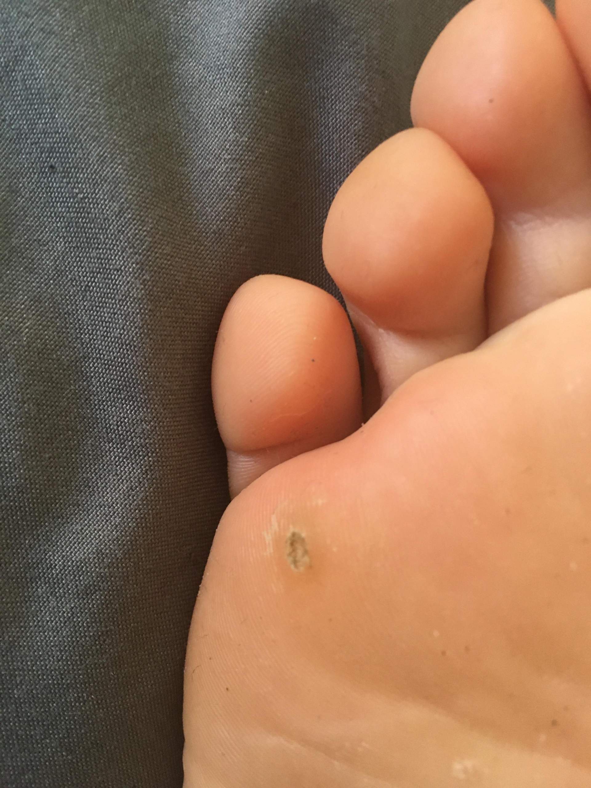 Warze Am Fuss Gesundheit Und Medizin Warzen Warze Am Fuss Gesundheit Und Medizin Warzen