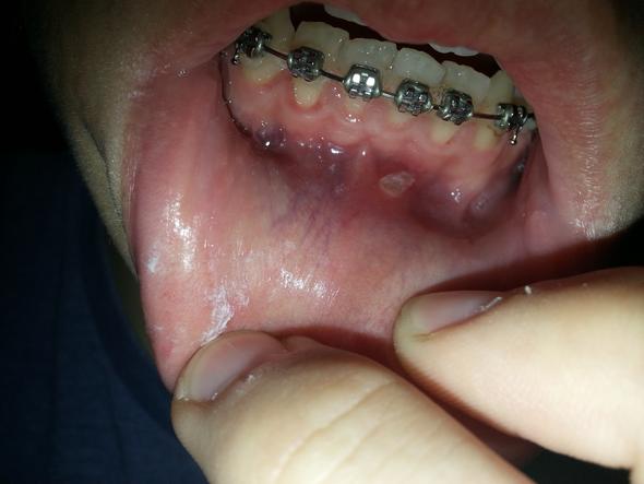 Entzündung, weißer Punkt - (Entzündung, Zahnfleisch)
