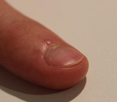 Warze bei Fingernagel Wurzel - (Medizin, Hautpflege)
