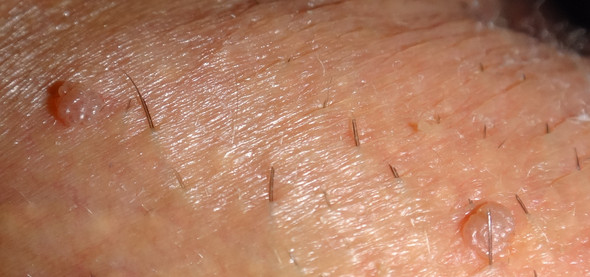 Im bereich warze intim PIckel oder