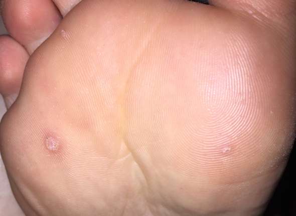 Warze, Hühnerauge..? (Gesundheit, Haut, Warzen) Warze, Hühnerauge..? (Gesundheit, Haut, Warzen)