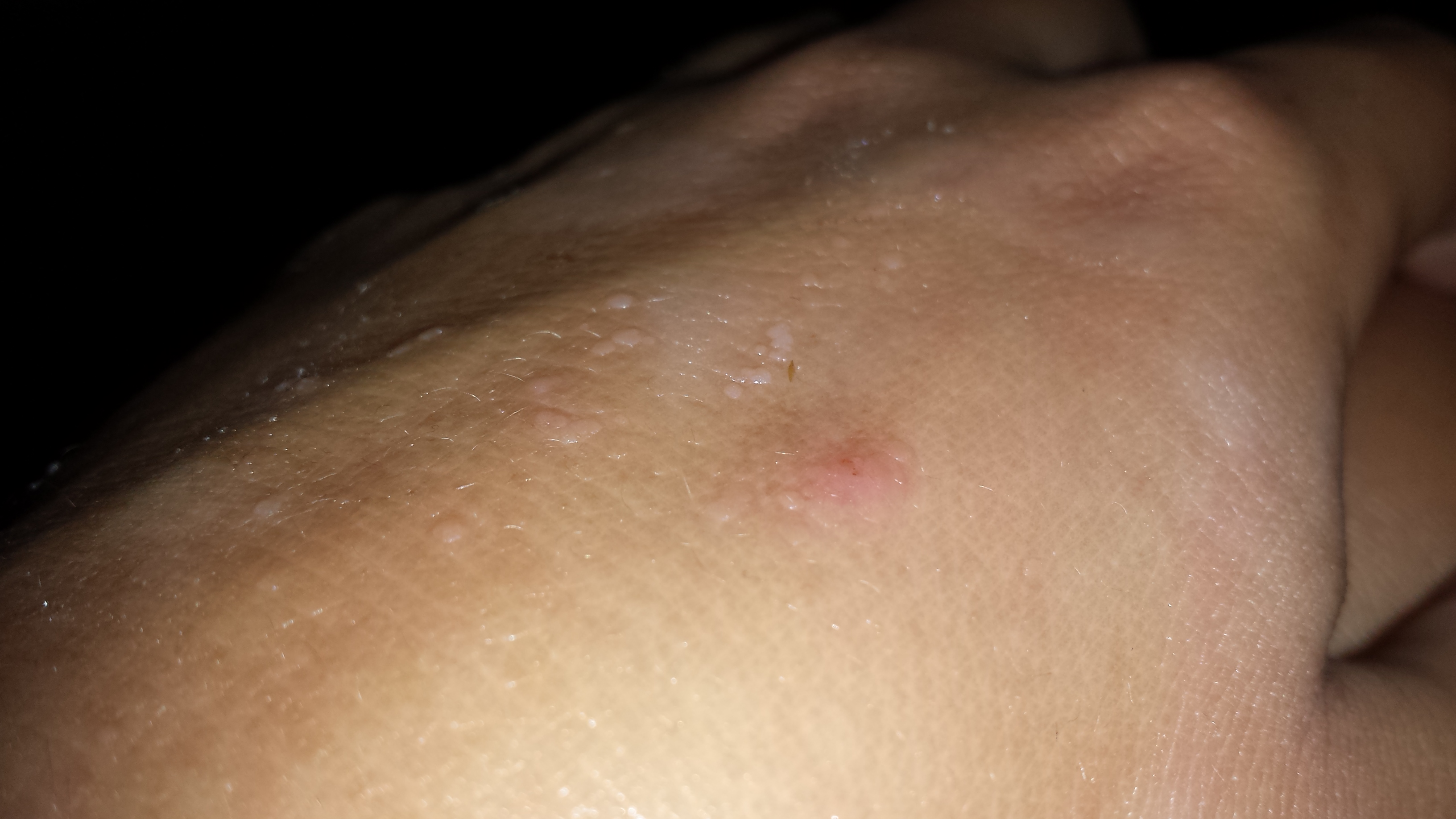 Warzen? HILFE! (Warzenbehandlung) Warzen? HILFE! (Warzenbehandlung)