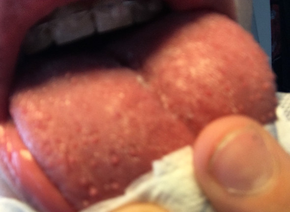 Warzen Auf Der Zunge Feigwarzen Gesundheit Geschlechtskrankheit Warzen Auf Der Zunge Feigwarzen Gesundheit Geschlechtskrankheit