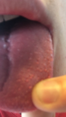 Warzen Auf Der Zunge Feigwarzen Gesundheit Geschlechtskrankheit Warzen Auf Der Zunge Feigwarzen Gesundheit Geschlechtskrankheit