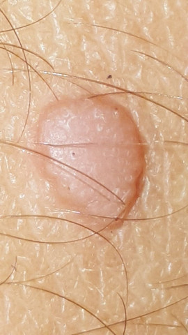 Knie - (Warzen, hühnerauge)