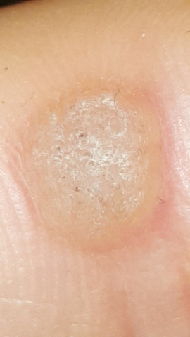 Finger - (Warzen, hühnerauge)