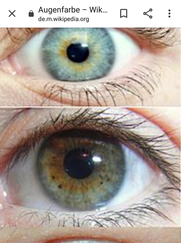 Was bedeuten die schwarzen Flecken in der Iris? (Gesundheit und Medizin