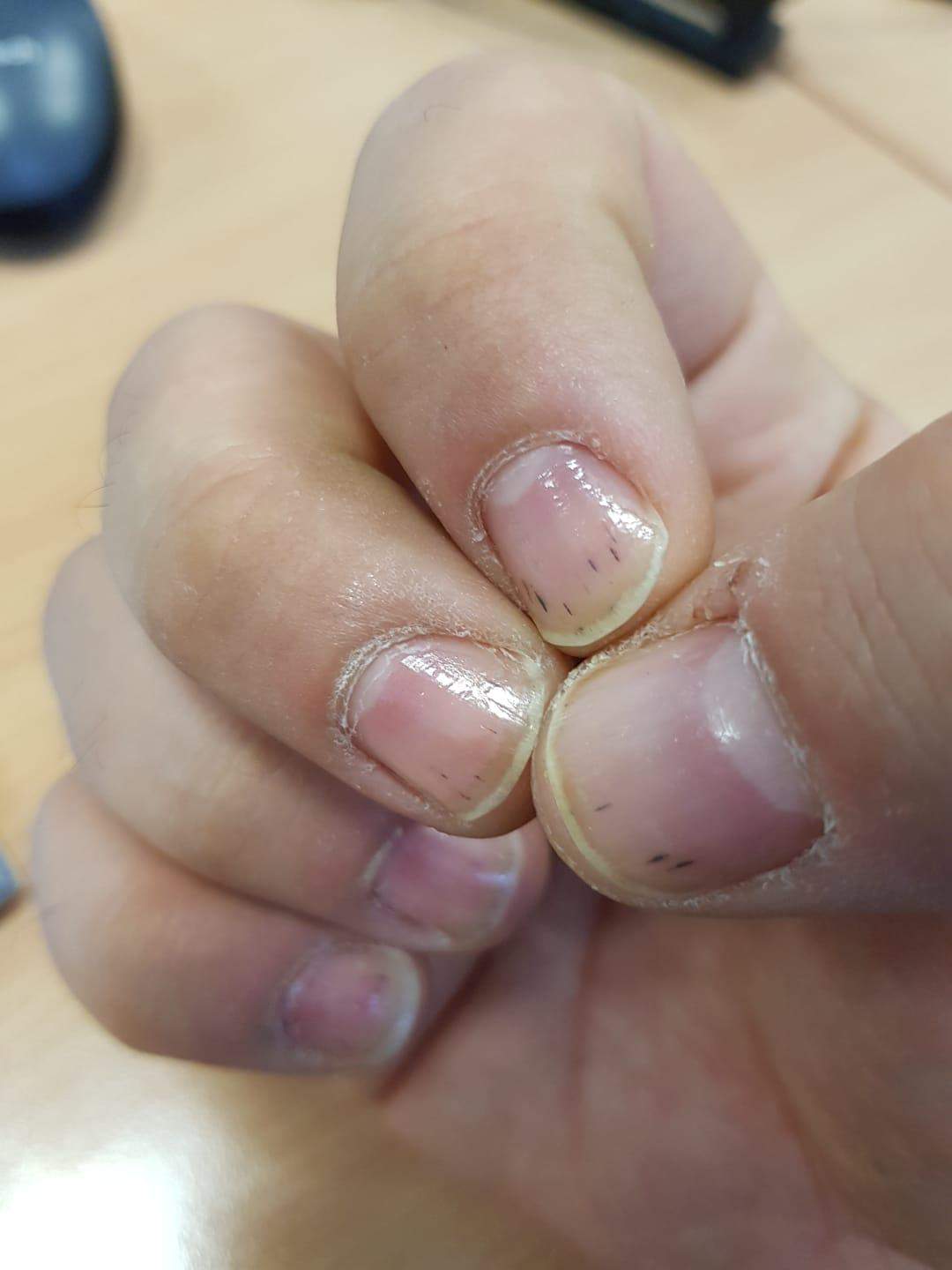 Was bedeuten diese schwarzen Striche/Linien unter/auf dem Fingernagel