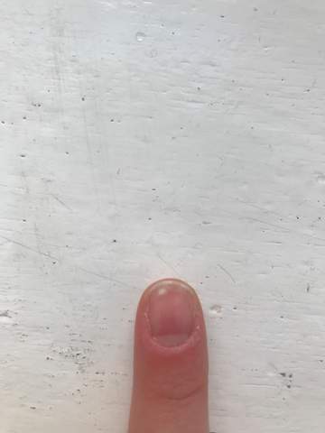 Was bedeuten weiße Punkte auf Nägeln?