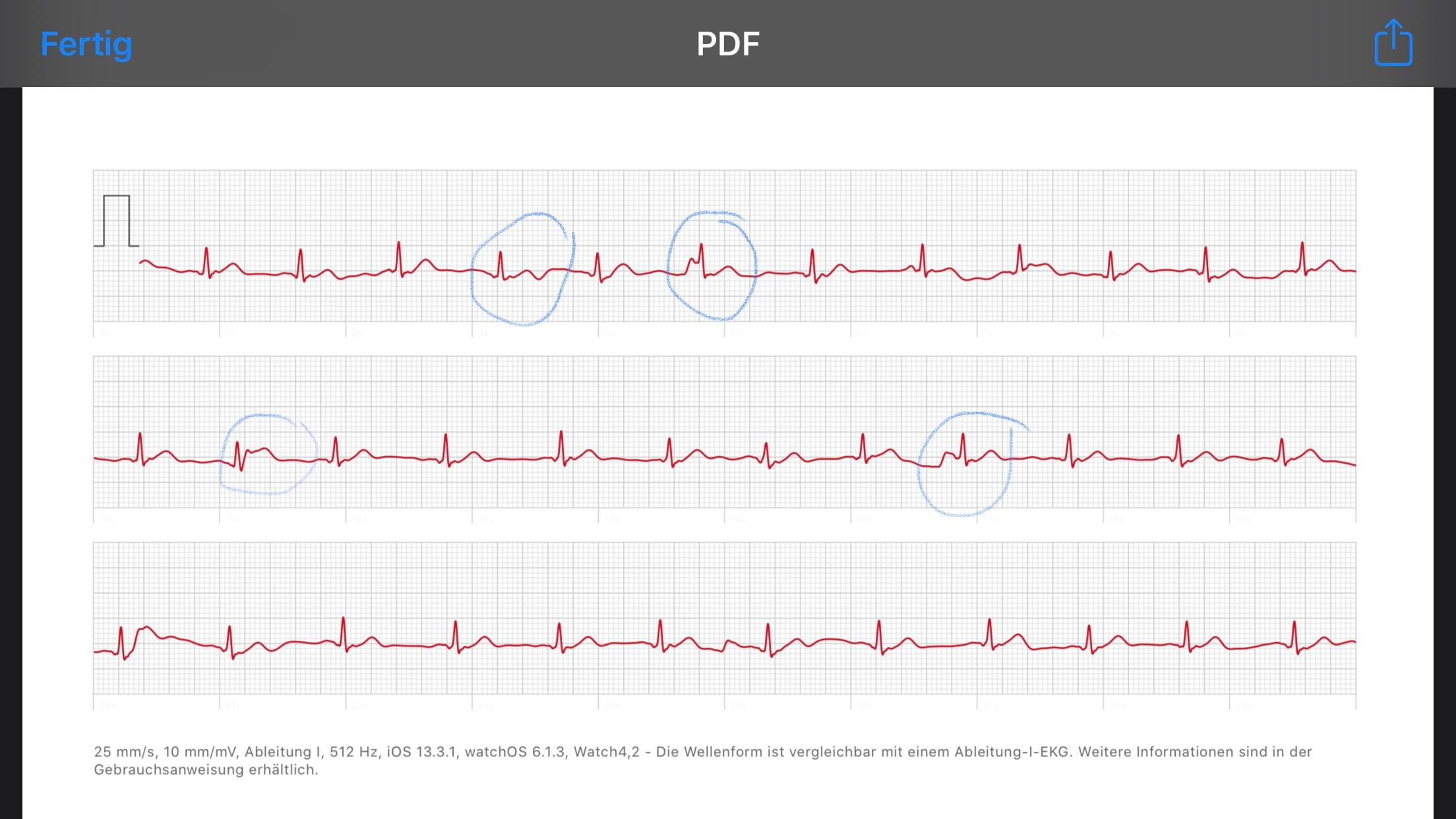 Was Bedeutet Das EKG Gesundheit Und Medizin Herz Herzrhythmusst rungen was-bedeutet-das-ekg-gesundheit-und-medizin-herz-herzrhythmusst-rungen