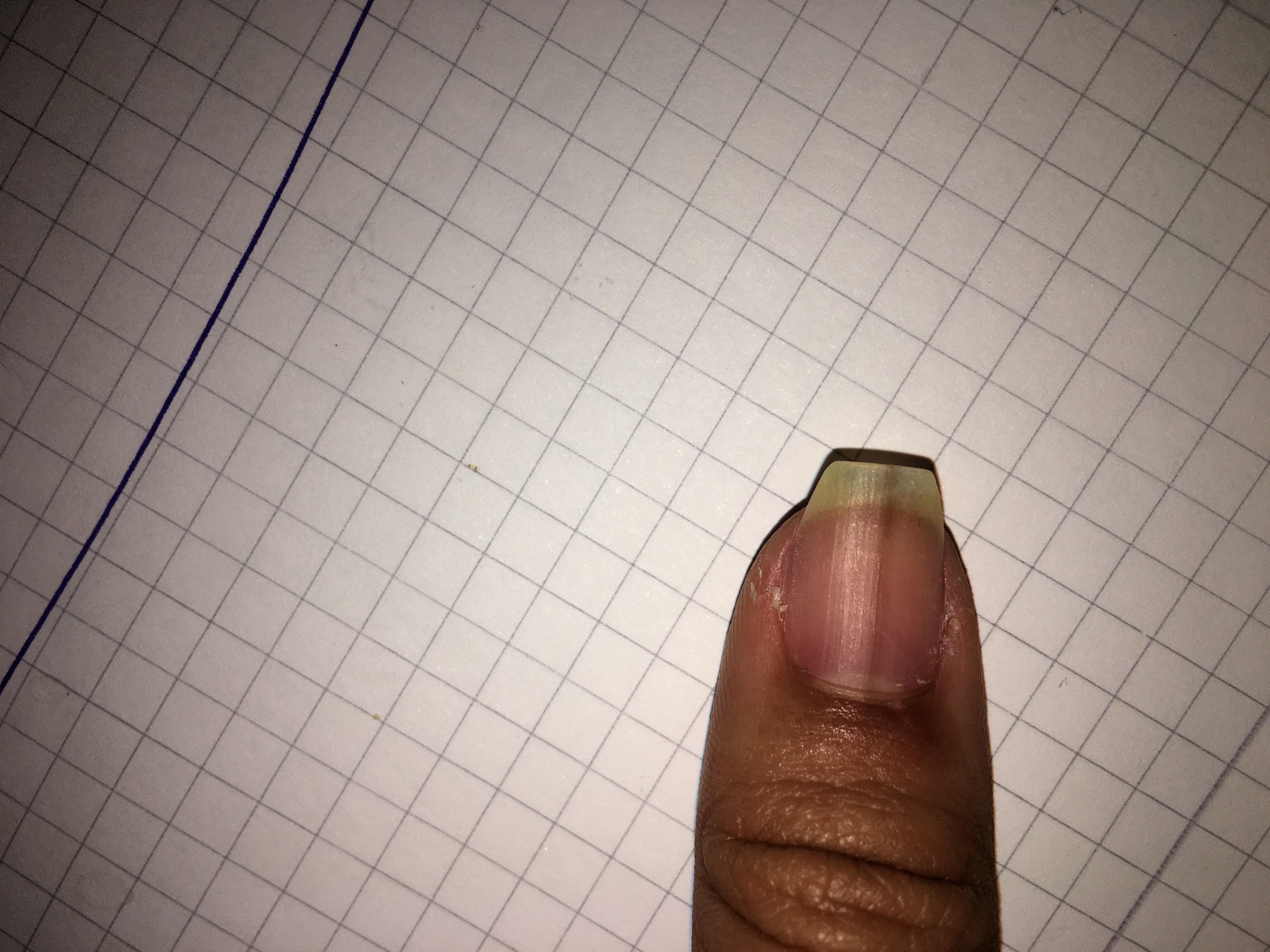 Was bedeutet ein Schwarz strich seit mehr 2 Jahren im Nagel(Daumen)? (Gesundheit, Körper)