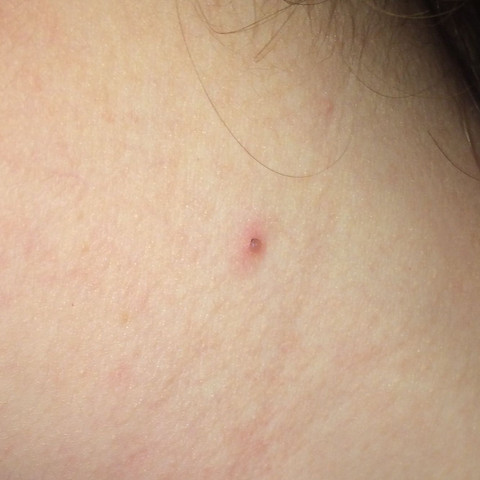 Was Bitte Ist Das An Meinem Hals Haut Knubbel Was Bitte Ist Das An Meinem Hals Haut Knubbel