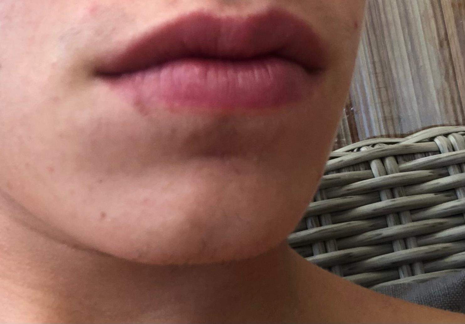 Was denkt ihr ist das für eine dunkle Stelle an der Lippe? (Gesundheit und Medizin, Herpes)