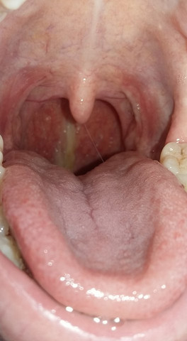 Was Fliesst Mir Da Standig Den Rachen Hinunter Gesundheit Und Medizin Gelber Schleim Was Fliesst Mir Da Standig Den Rachen Hinunter Gesundheit Und Medizin Gelber Schleim