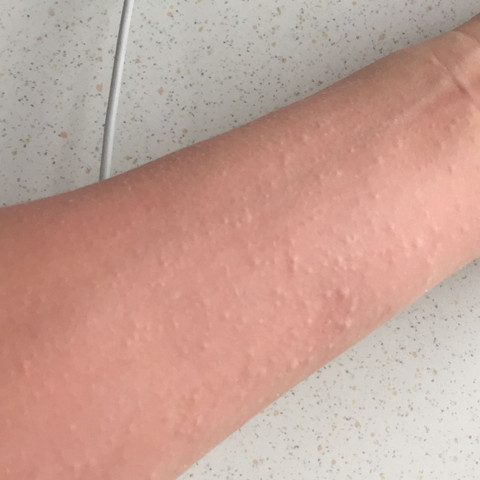 Sonnenallergie Youtube