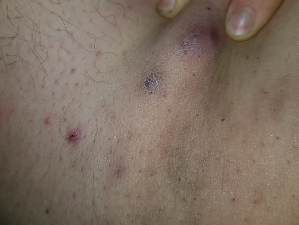 Was Fur Ein Pickel Ist An Meinem Oberschenkel Was Fur Ein Pickel Ist An Meinem Oberschenkel