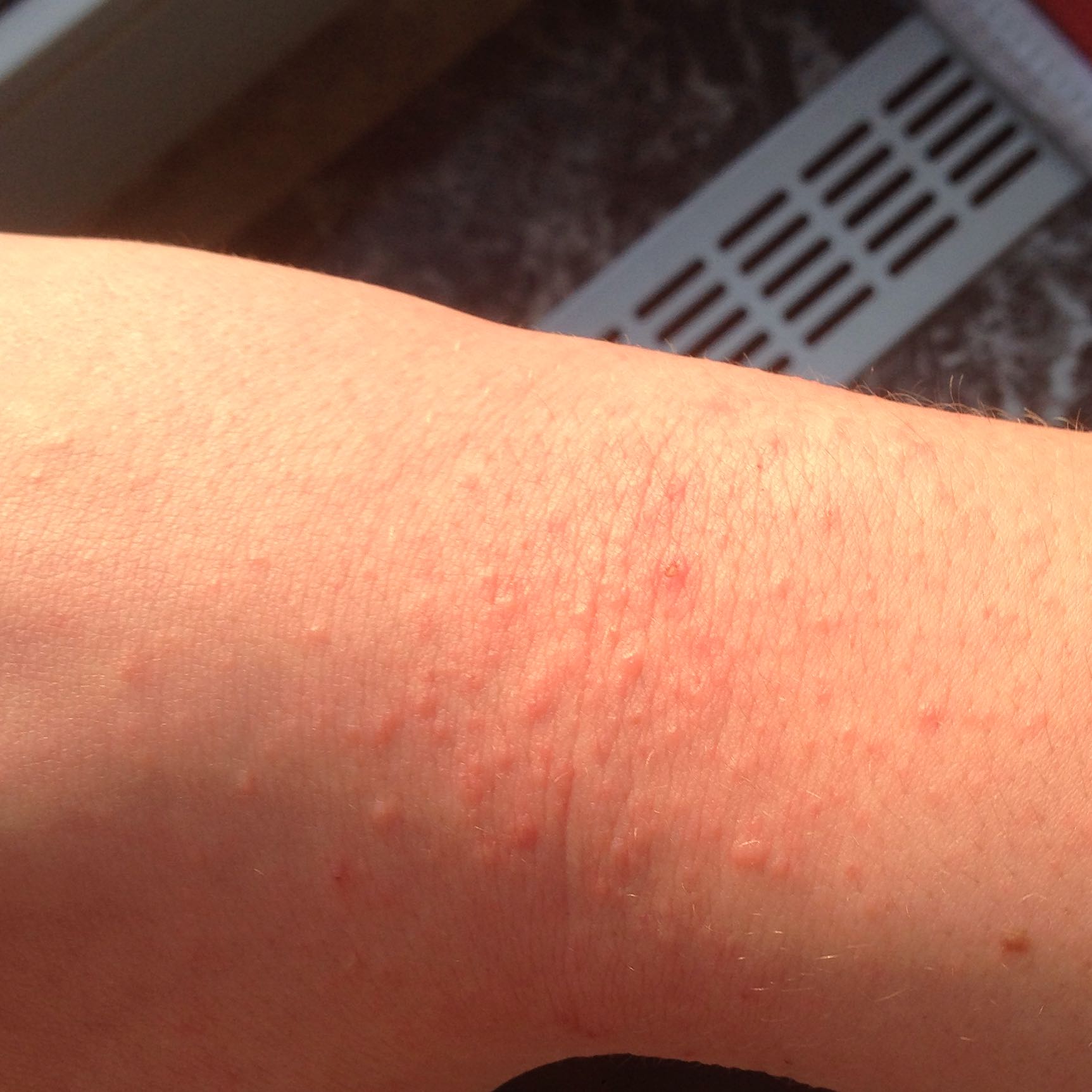 Was für ein Ausschlag ist das?:( (Gesundheit und Medizin, Haut, Allergie)