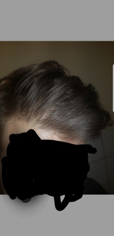 haarausfall typ bin ich haare