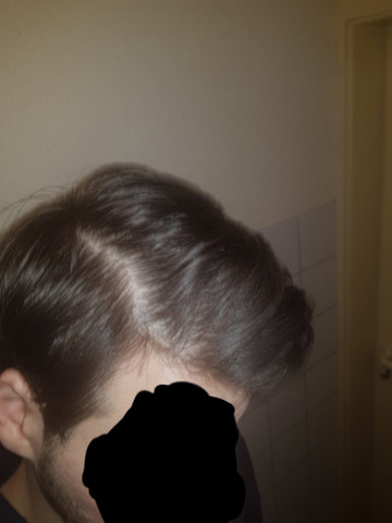 Was Fur Ein Haarausfall Typ Bin Ich Haare Haarausfall Stoppen