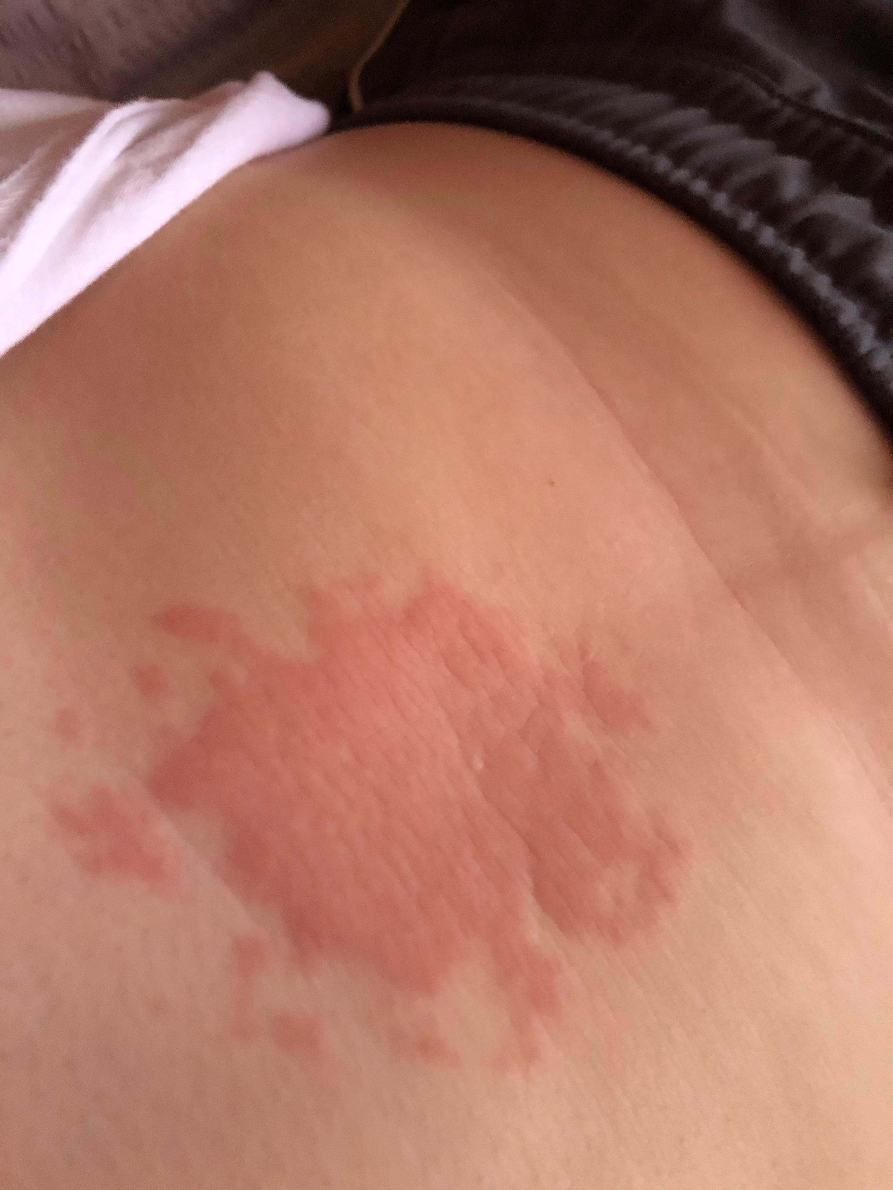 Was für ein Hautausschlag ist das? Hilfe bitte bitte? (Gesundheit und Was für ein Hautausschlag ist das? Hilfe bitte bitte? (Gesundheit und