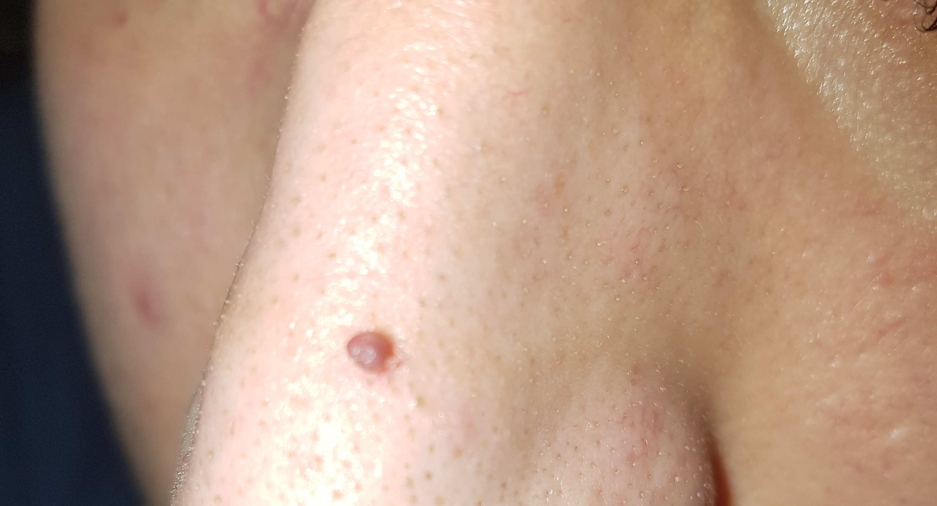 pickel an der nase pickel an der nase