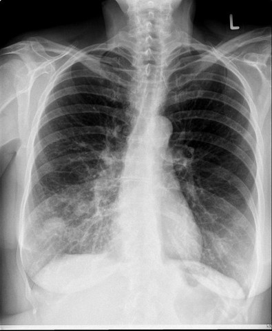 Raumvedrängung rechte Lunge - (Medizin, Lunge, Tumor)