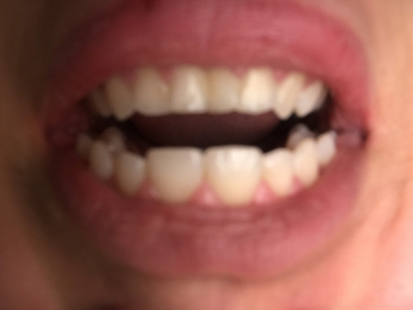 Was Fur Eine Zahnspange Konnte Ich Gebrauchen Gesundheit Und Medizin Zahne Zahnarzt Was Fur Eine Zahnspange Konnte Ich Gebrauchen Gesundheit Und Medizin Zahne Zahnarzt