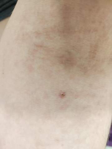 Was für einen Krankheit liegt bei diesem Hautausschlag vor?