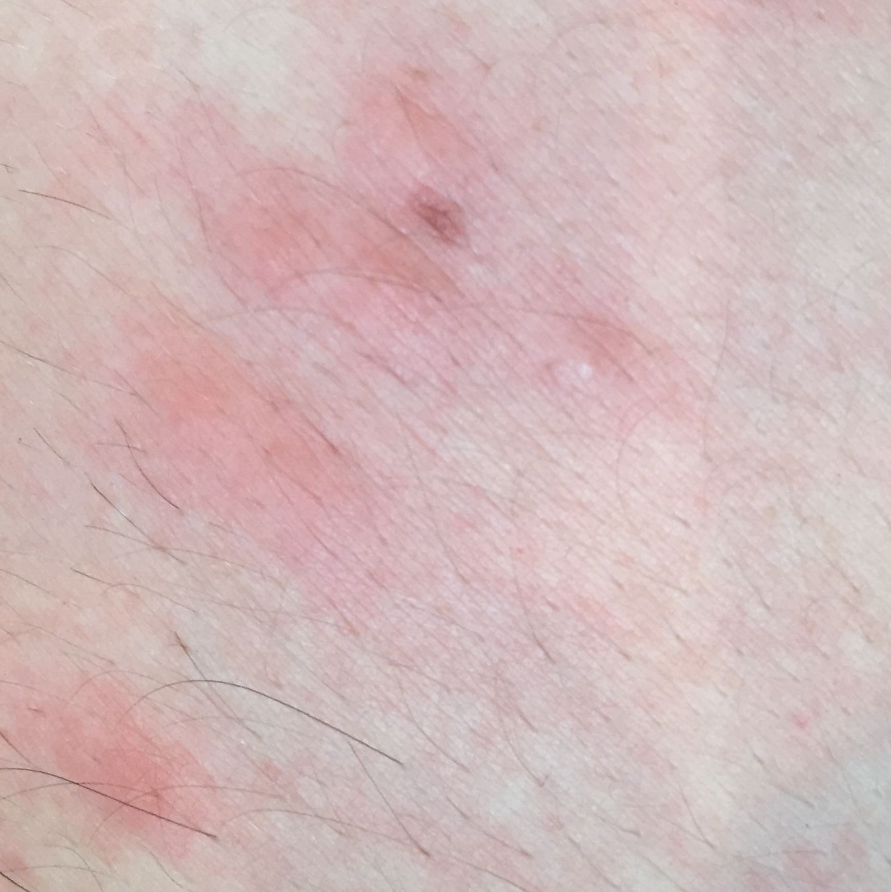 Was für Stiche sind das um den Bauchnabel? (Gesundheit und Medizin, Stich) Was für Stiche sind das um den Bauchnabel? (Gesundheit und Medizin, Stich)