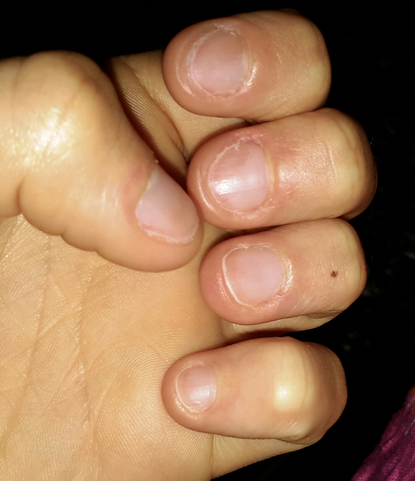 Was Gegen Abgekaute Nagel Tun Kauen