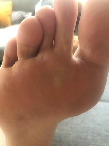 Was Gegen Blase Am Fuss Tun Gesundheit Und Medizin Gesundheit Fusse Was Gegen Blase Am Fuss Tun Gesundheit Und Medizin Gesundheit Fusse