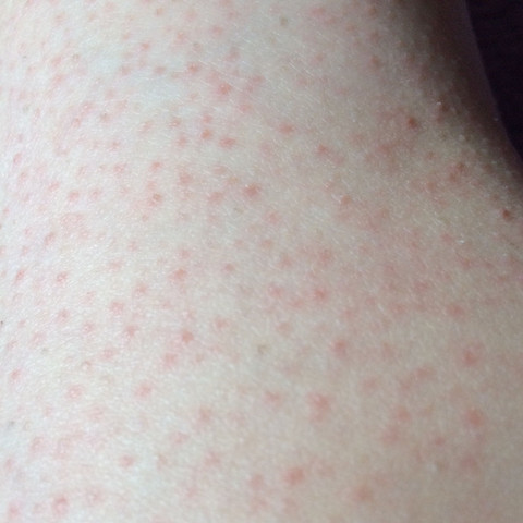 was gegen diese roten pickel tun