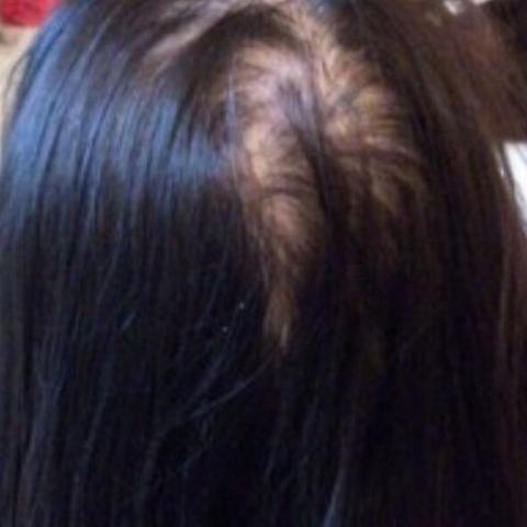 Was Tun Gegen Extremen Haarausfall Habe Schon Kahle Stellen Auf Dem Hinterkopf