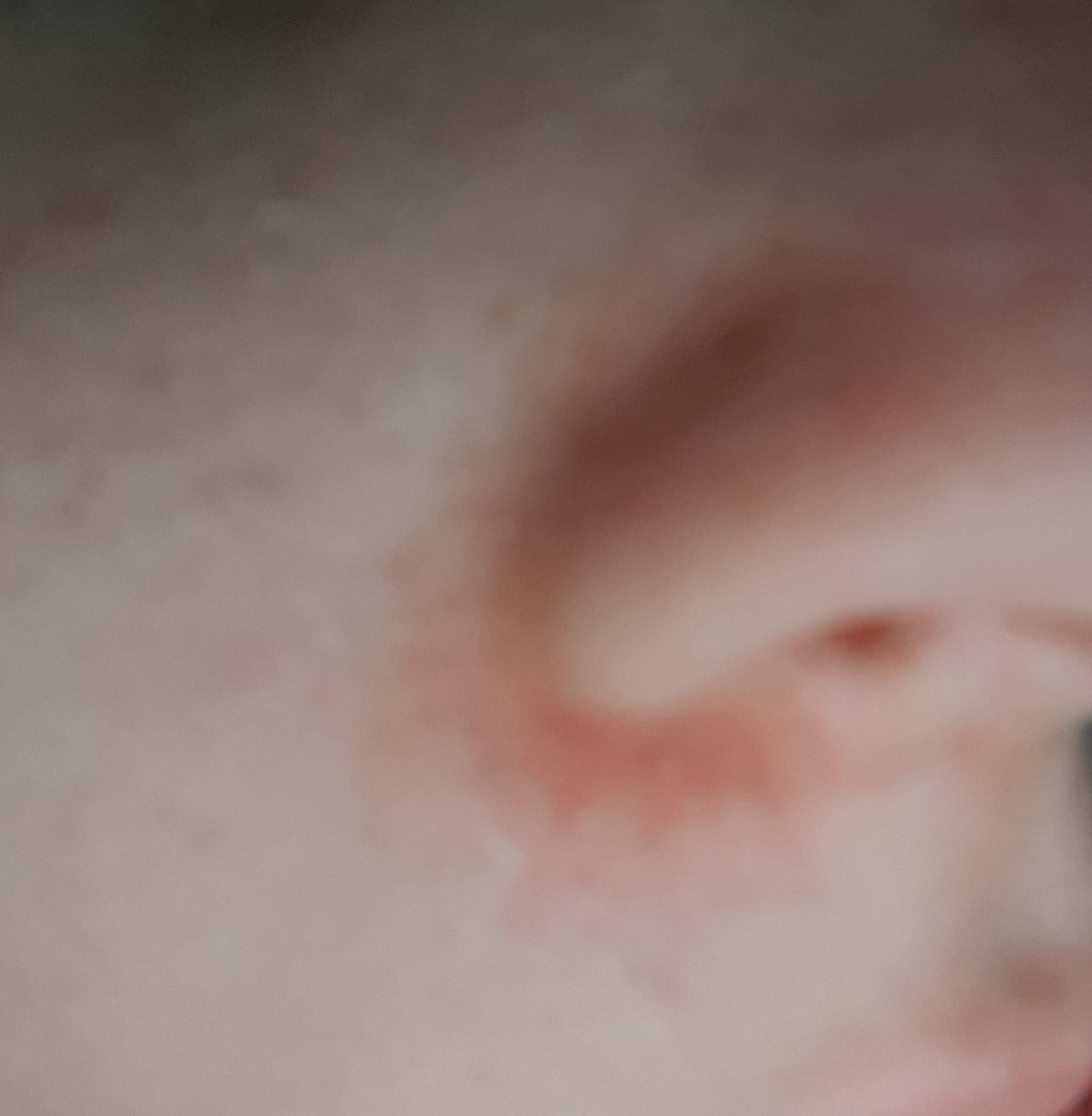 Was gegen Rötungen um Nase tun? (Hautpflege, Hautprobleme)