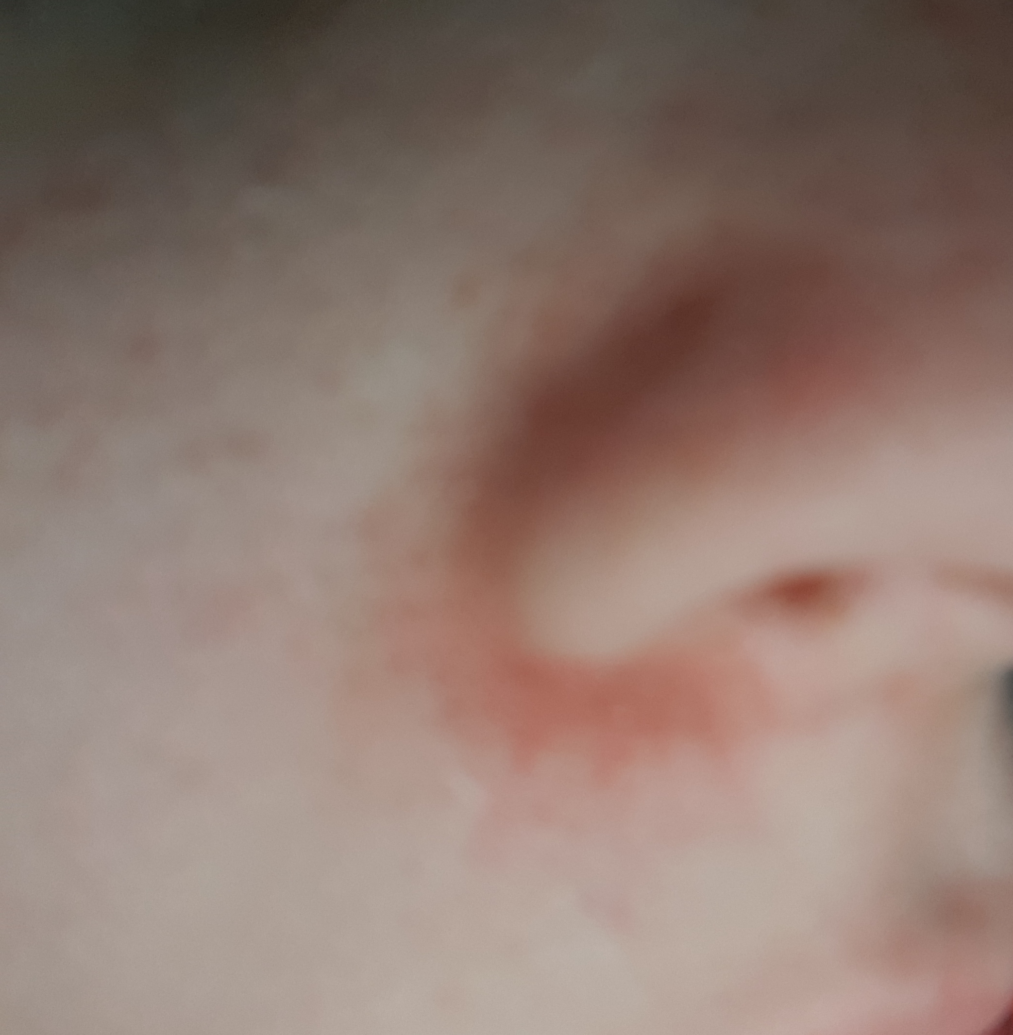 Was Gegen Rotungen Um Nase Tun Hautpflege Hautprobleme