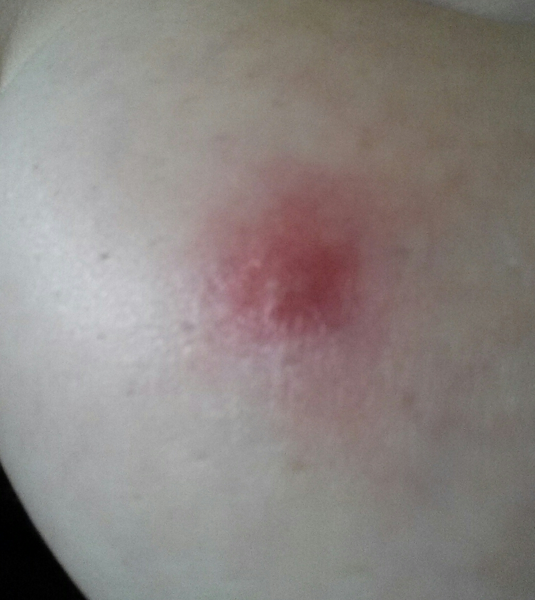 Was genau könnte das sein und wie kriege ich es weg? (Pickel, Brust) Was genau könnte das sein und wie kriege ich es weg? (Pickel, Brust)