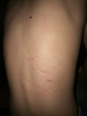 - (Haut, blau, 14jahren)