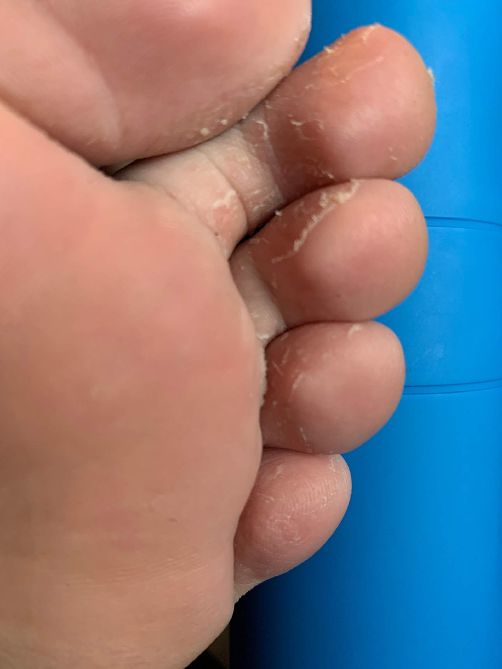 Was Hab Ich An Den Zehen Haut Fusse Was Hab Ich An Den Zehen Haut Fusse