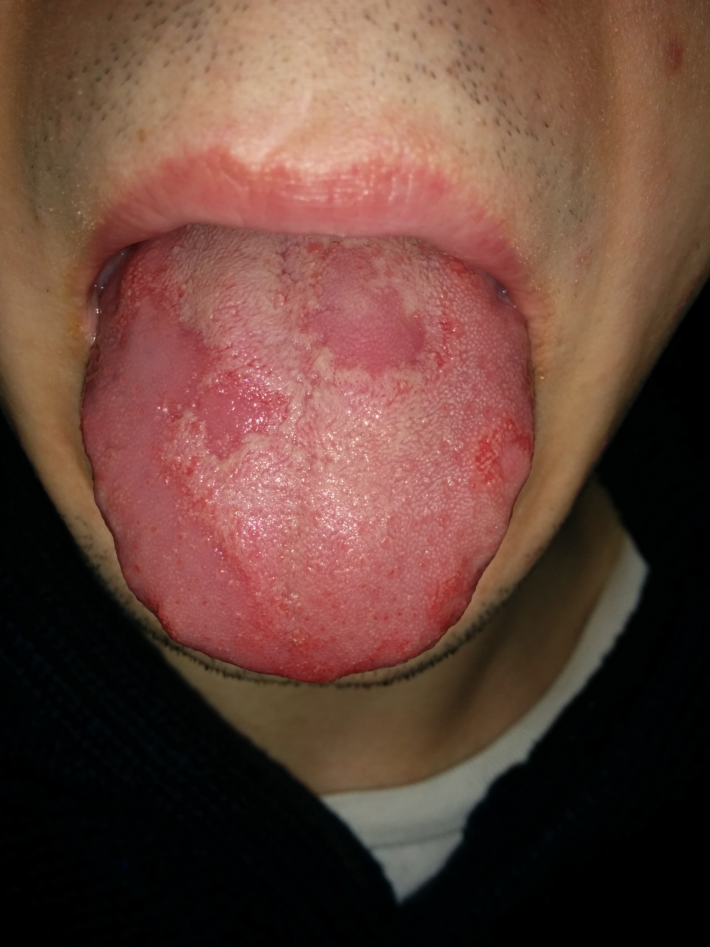 Was hab ich da auf der zunge? (Krebs, Allergie, Mund) Was hab ich da auf der zunge? (Krebs, Allergie, Mund)
