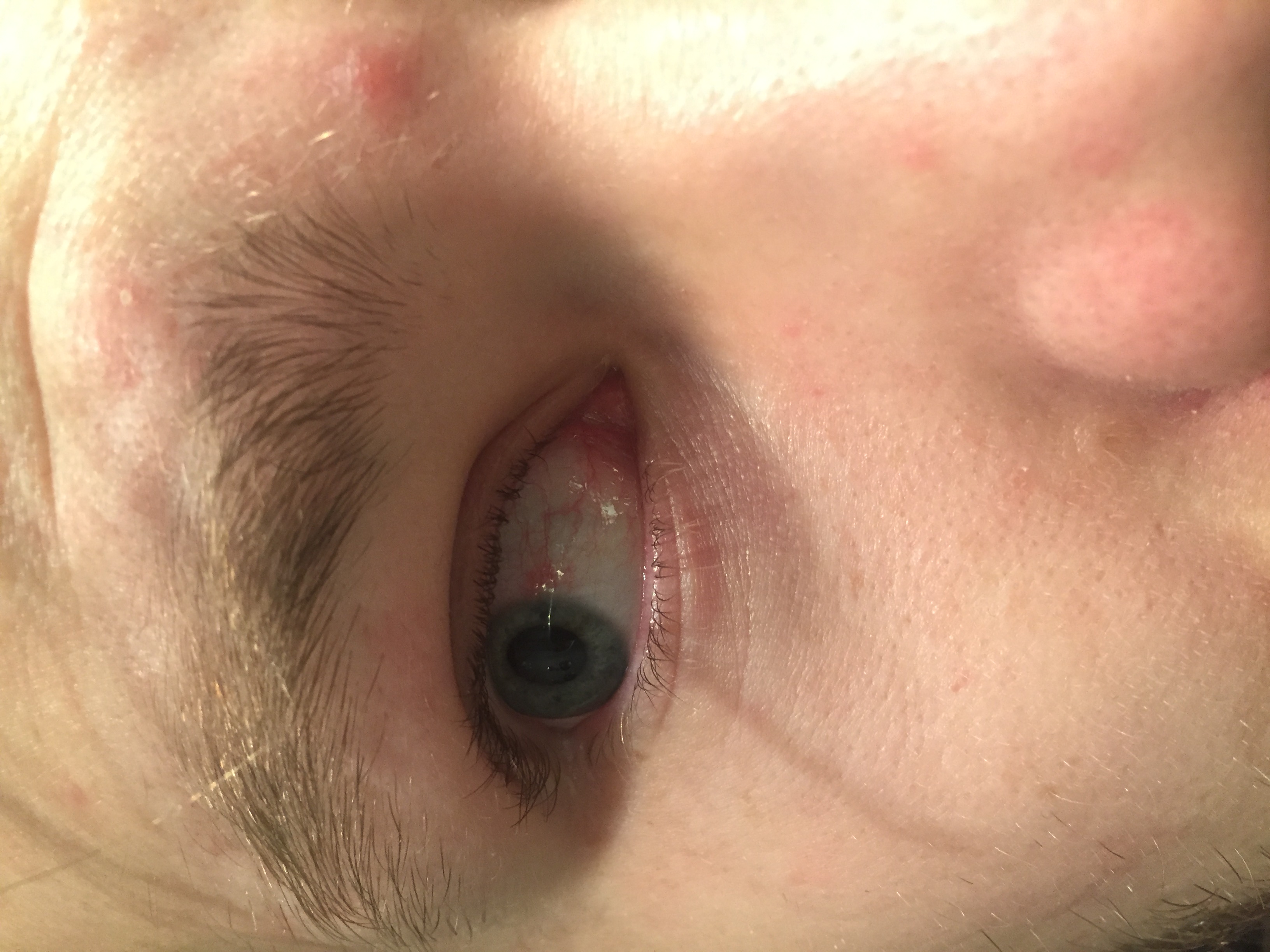 Was habe ich am Auge, Arzt zu unkompetent ? (Augen)