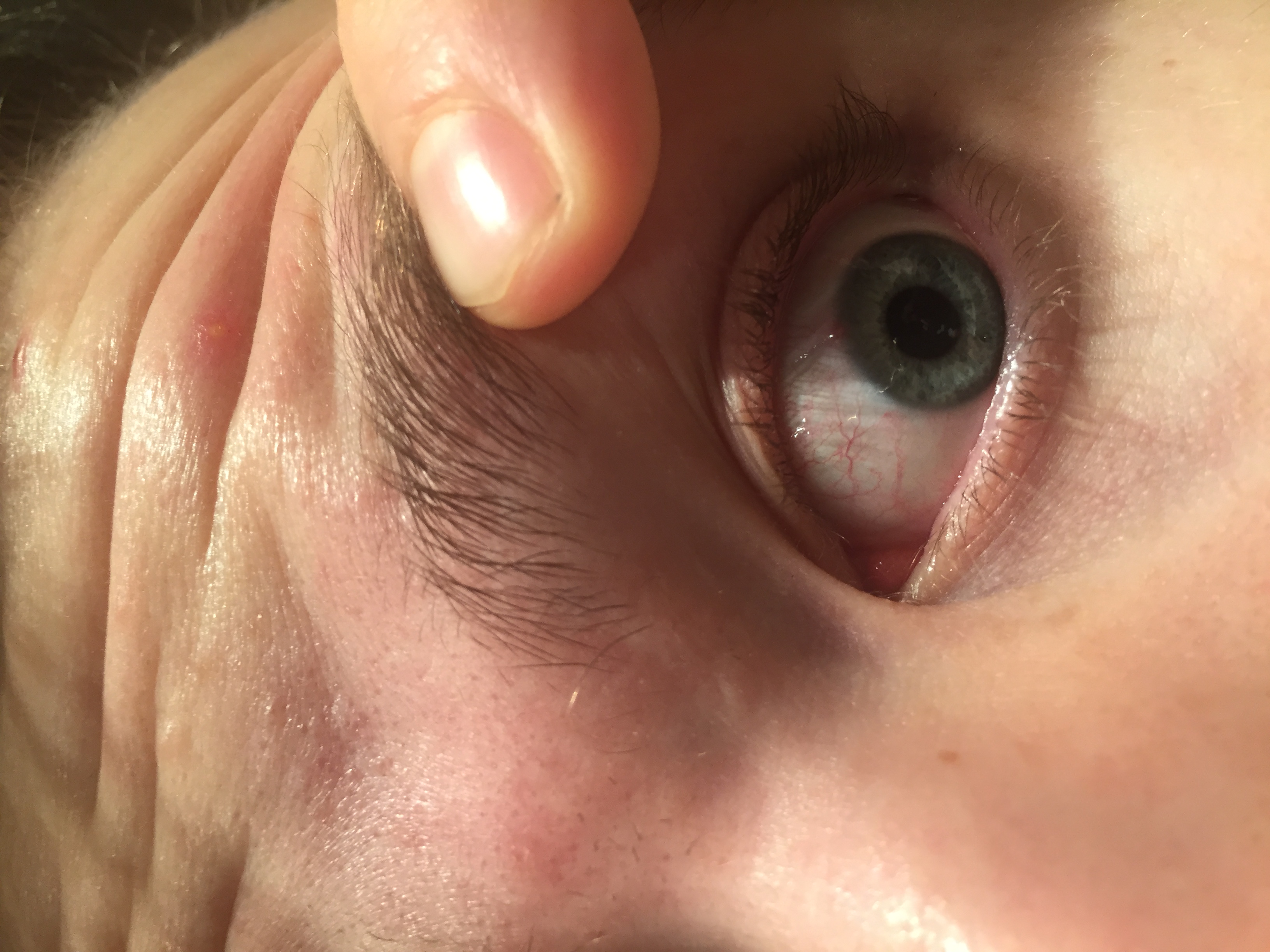 32++ Rheuma im auge bilder , Was habe ich am Auge, Arzt zu unkompetent ? (Augen)