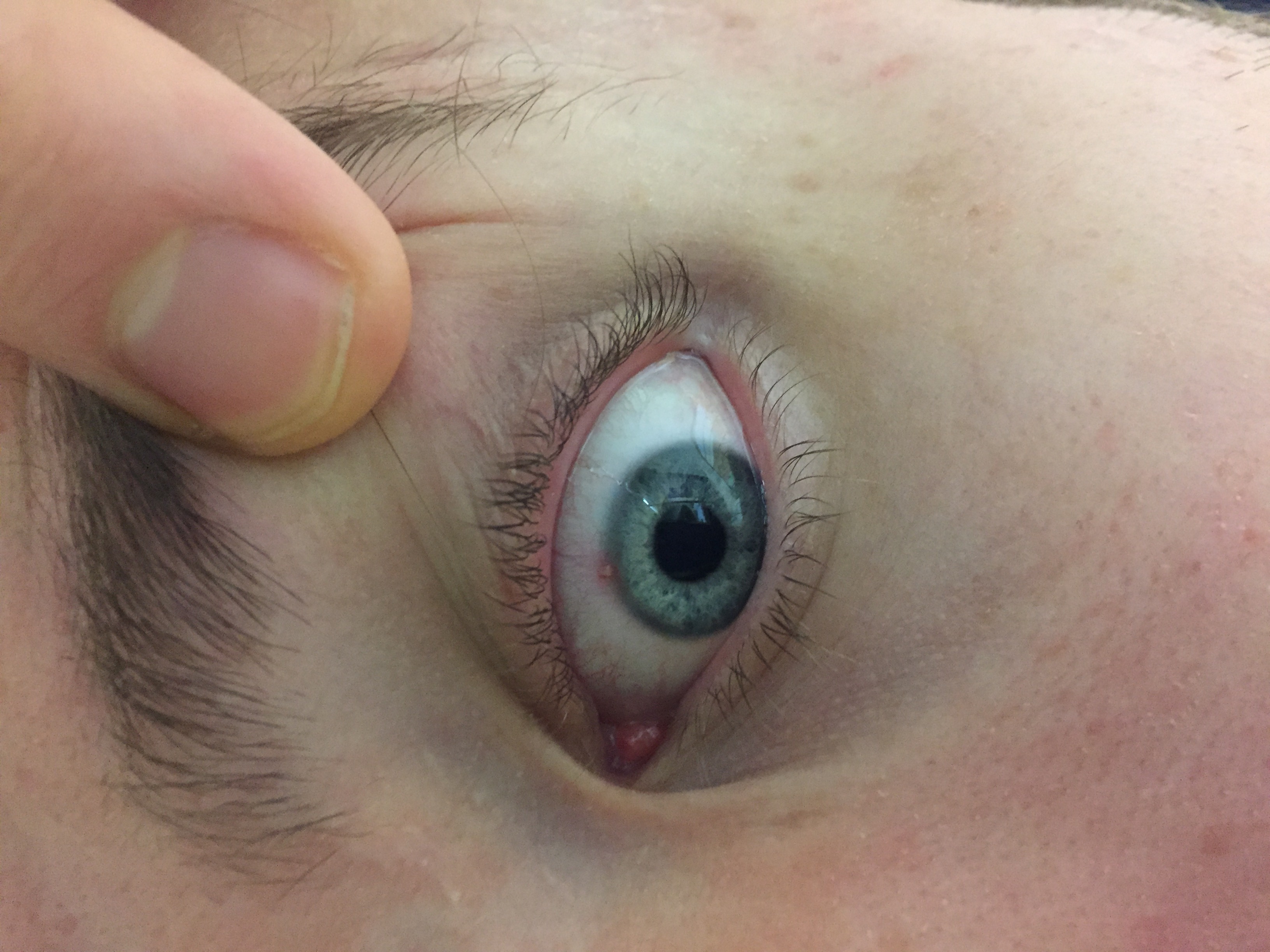 Was habe ich am Auge, Arzt zu unkompetent ? (Augen)