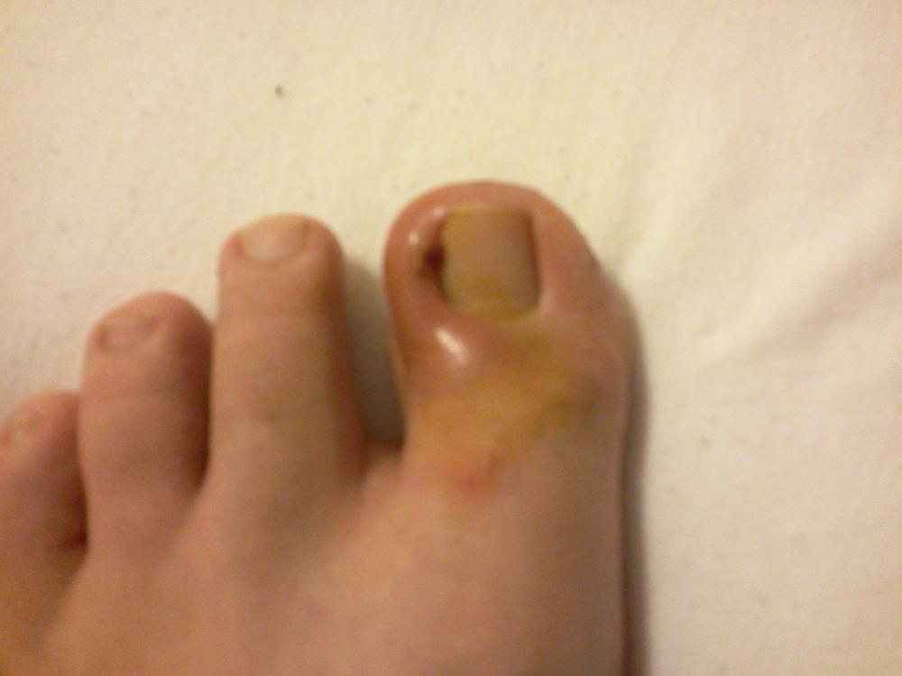 was habe ich am zeh? und wie heile ich es? (Füße, Entzündung) was habe ich am zeh? und wie heile ich es? (Füße, Entzündung)