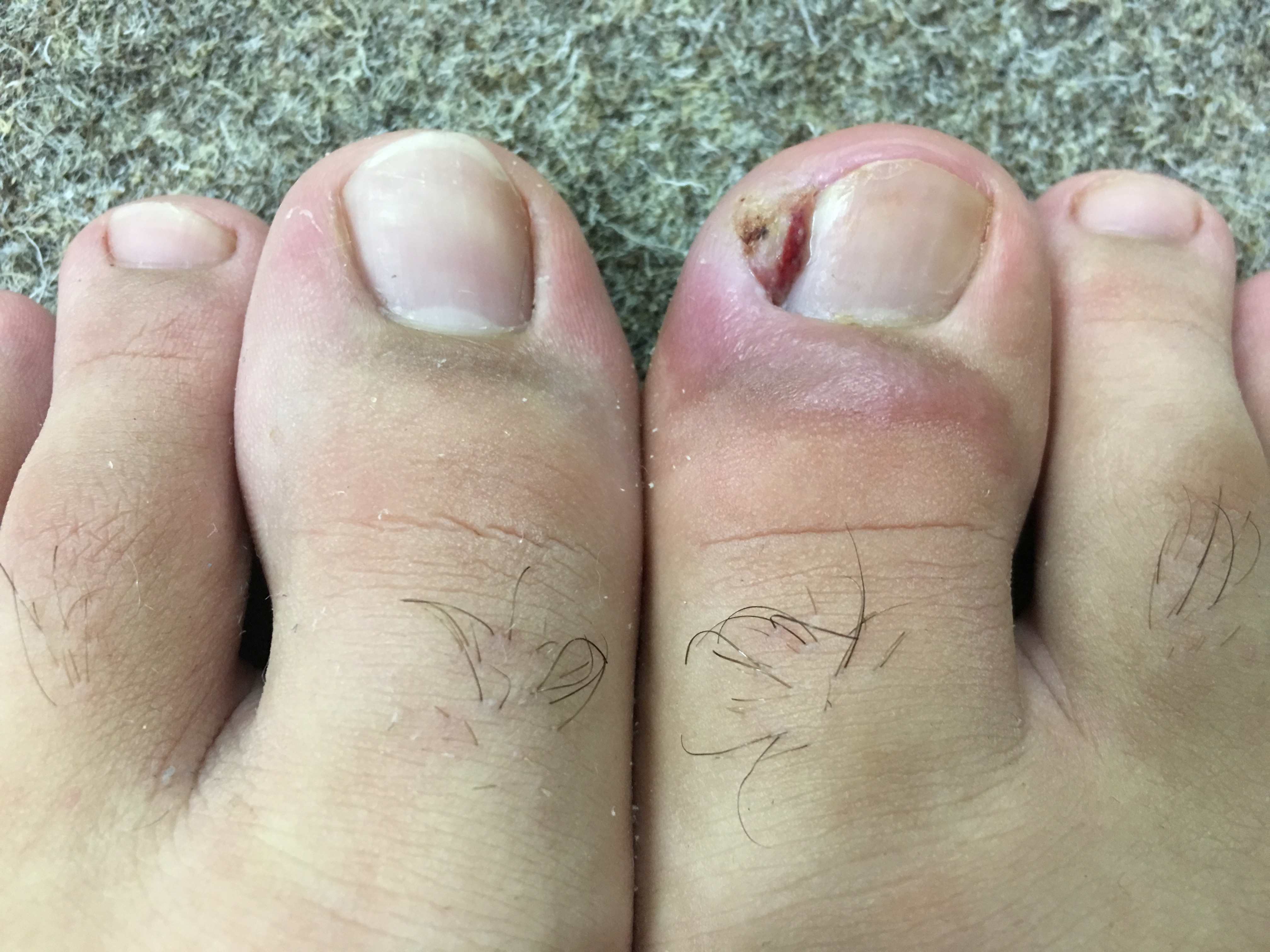 Was habe ich am Zeh? (Gesundheit, Gesundheit und Medizin, Medizin) Was habe ich am Zeh? (Gesundheit, Gesundheit und Medizin, Medizin)