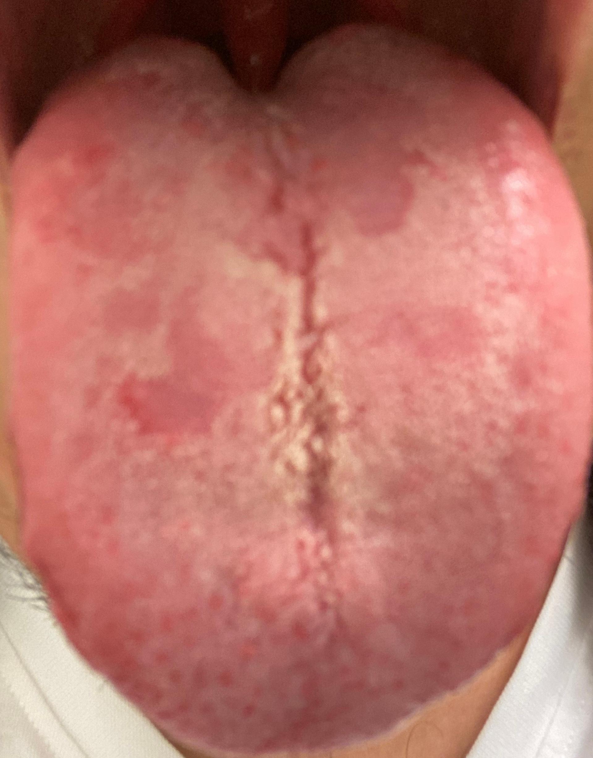 Was habe ich auf der Zunge? (Gesundheit und Medizin, Körper, Krankheit)