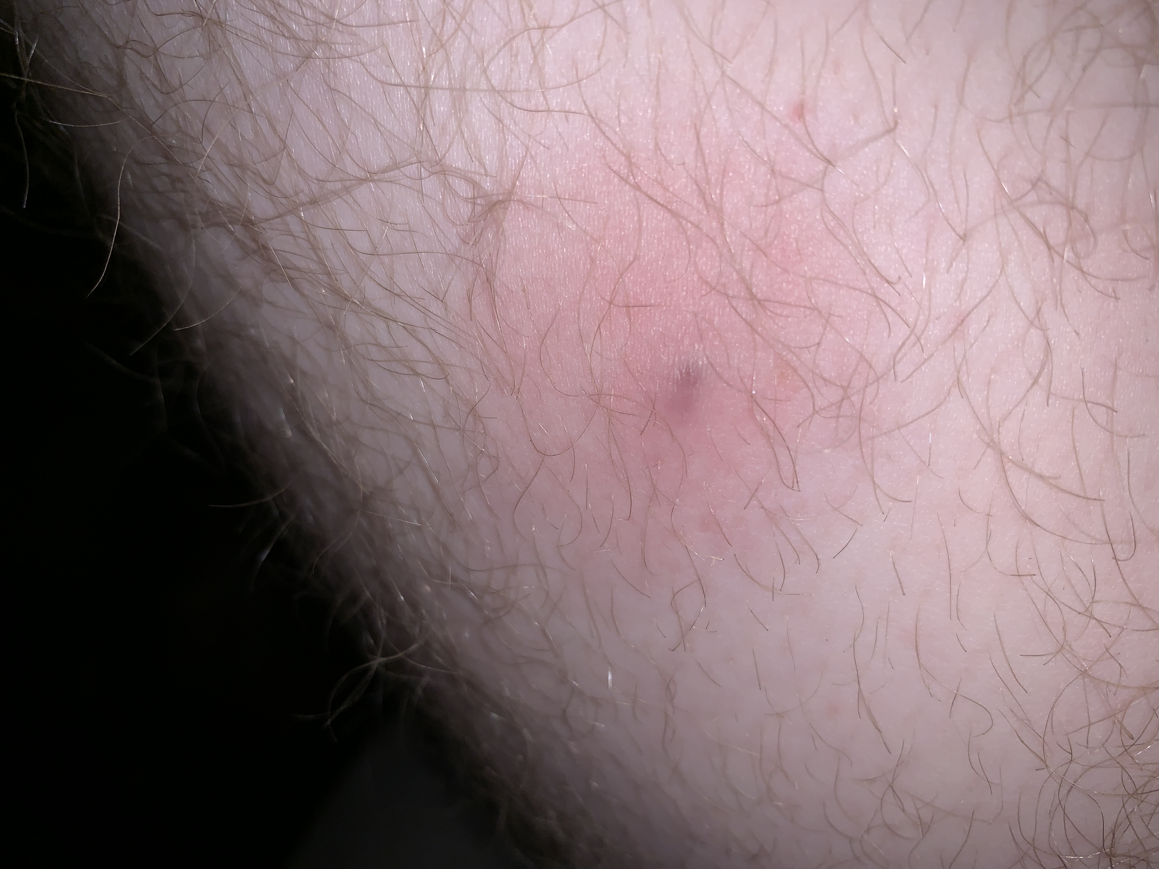 Was habe ich da an meinem Bein? Ein Pickel oder doch was anderes? (Gesundheit, Gesundheit und pickel auf beinen